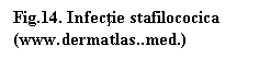 Text Box: Fig.14. Infectie stafilococica (www.dermatlas..med.)