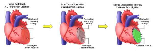 myocardial_infarction