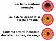 ateroscleroza1